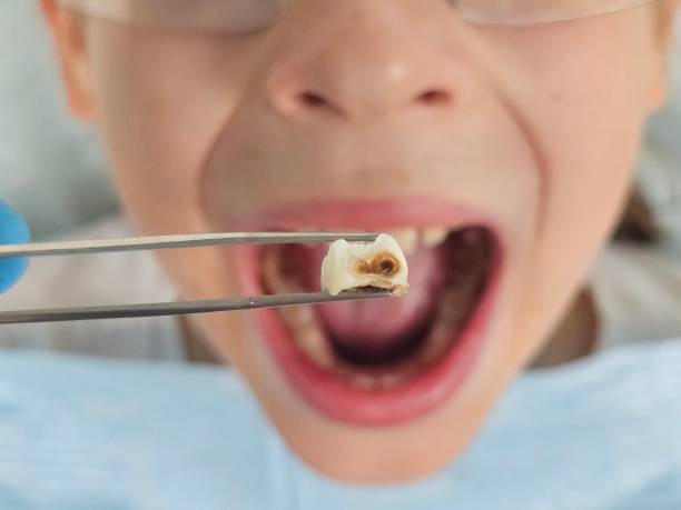 Best Emergency Root Canal Treatment in Fallbrook, CA